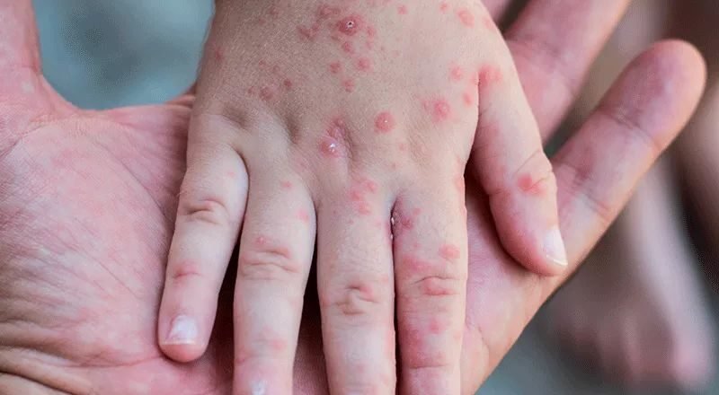 Medellín implementa acciones frente al brote de viruela del mono. La Secretaría de Salud lanza recomendaciones